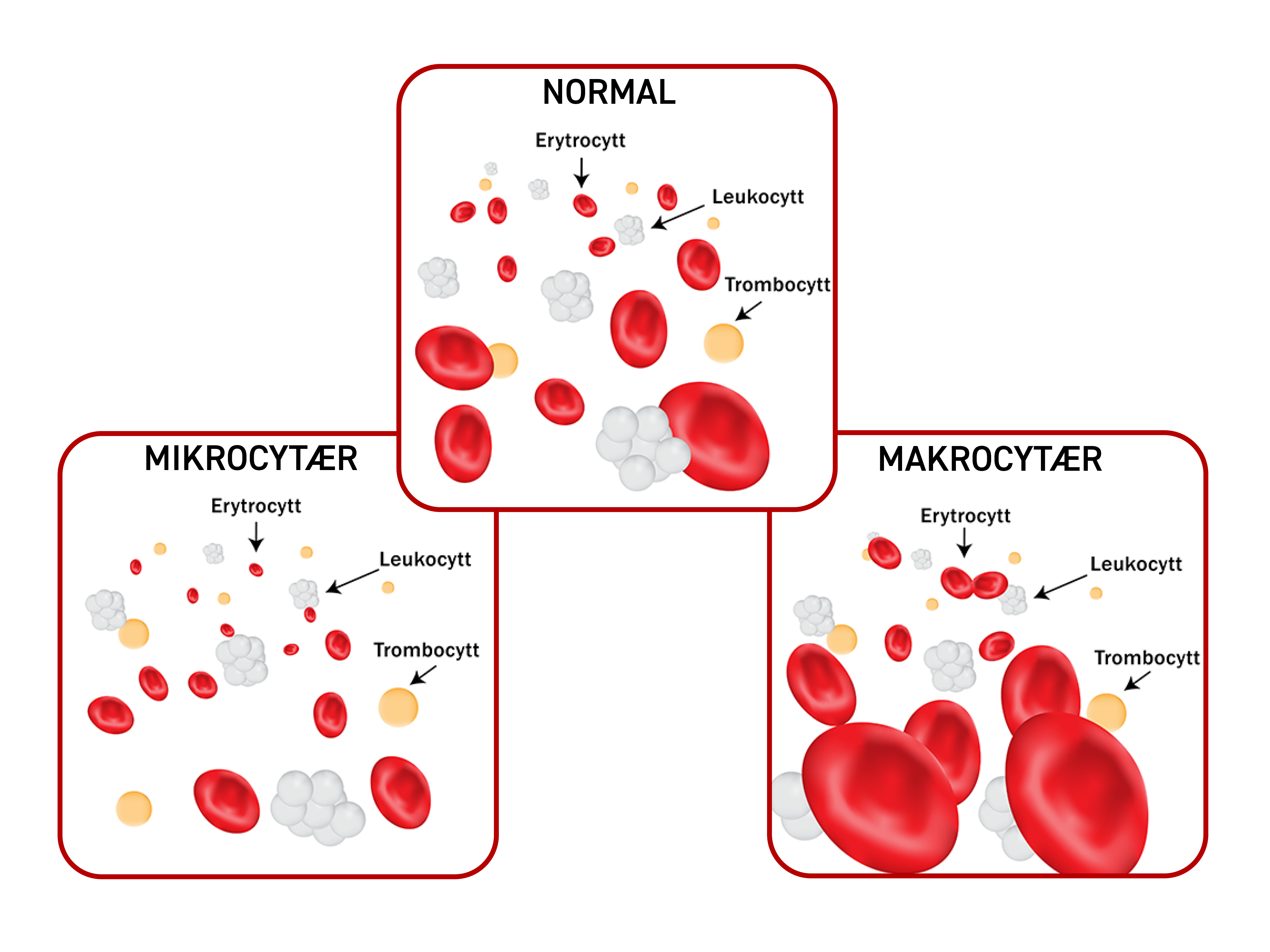 Representasjon av normalt blodbilde og mikrocytær / makrocytær anemi